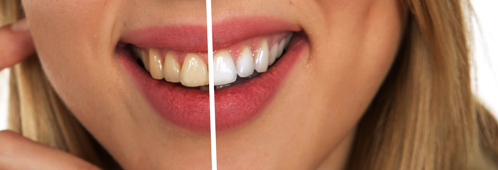 Lady Smiling Before Teeth Whitening and After Teeth Whitening